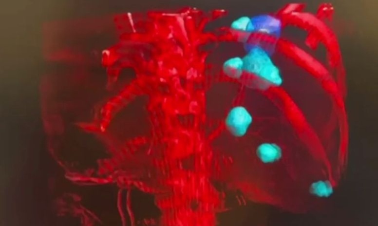 Точечный удар по раку: в онкоцентре в Калининграде творят чудеса